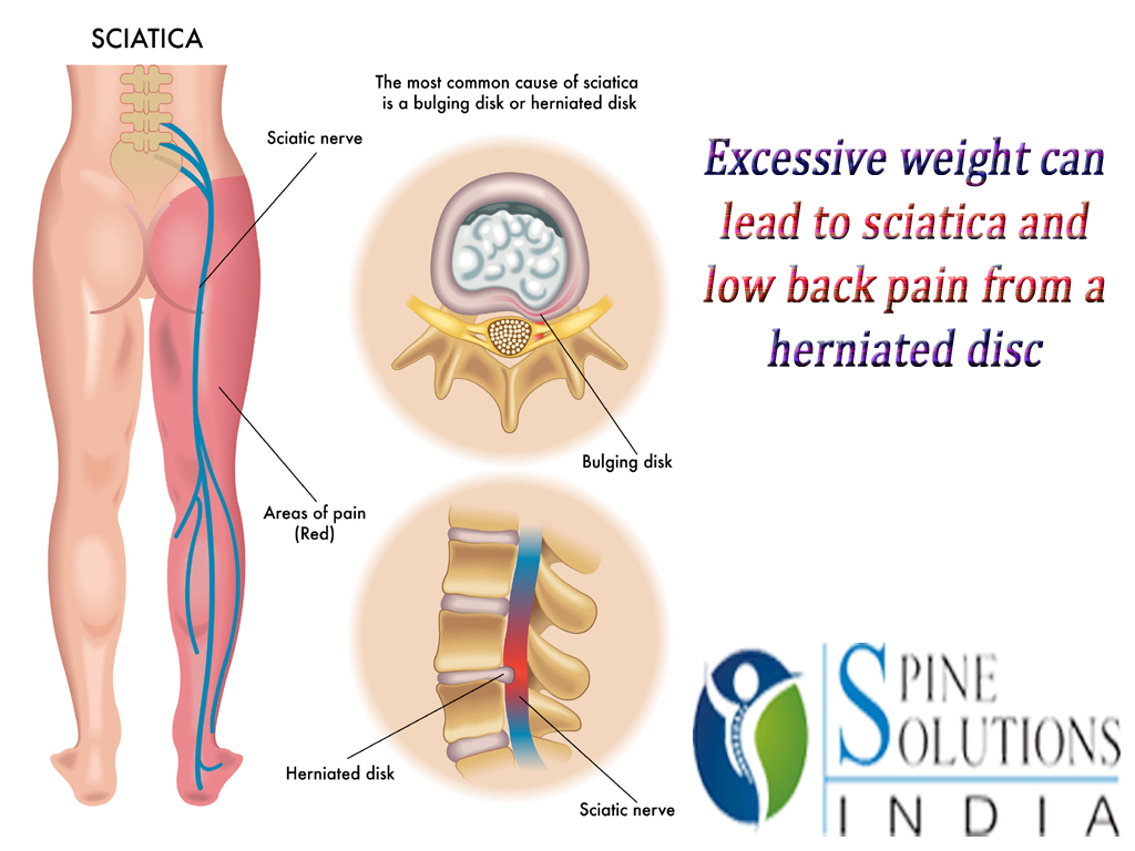 Spine Solutions India by Dr Sudeep Jain Excessive weight can lead to