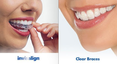  Chi phí niềng răng không mắc cài 3D Clear