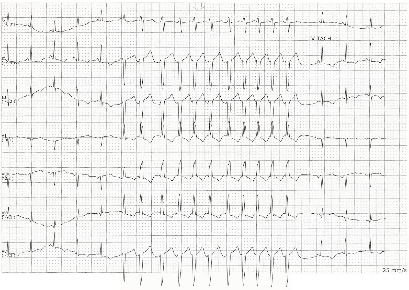 Float Nurse Sinus Rhythm with a Run of Ventricular Tachycardia