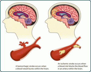 http://www.thebrainandspine.com/brain-tumor-surgery/