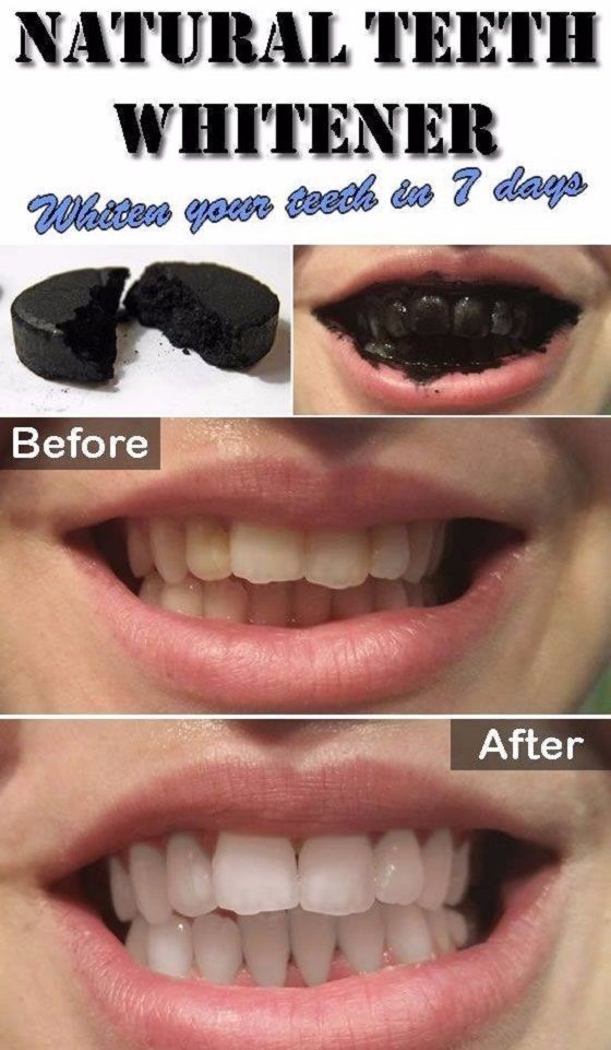 Natural Teeth Whitner 115