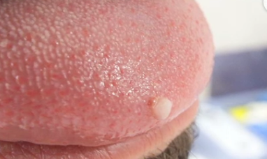 hpv nasil anlasilir uzman tv