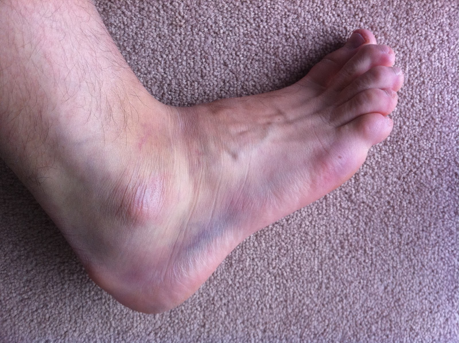 Paragon Physiotherapy Day 6 Post Ankle Sprain