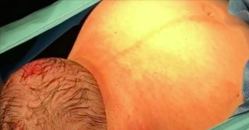 La maman va accoucher par césarienne. Puis quand la tête du bébé commence à sortir? La caméra capte ces images très rares.