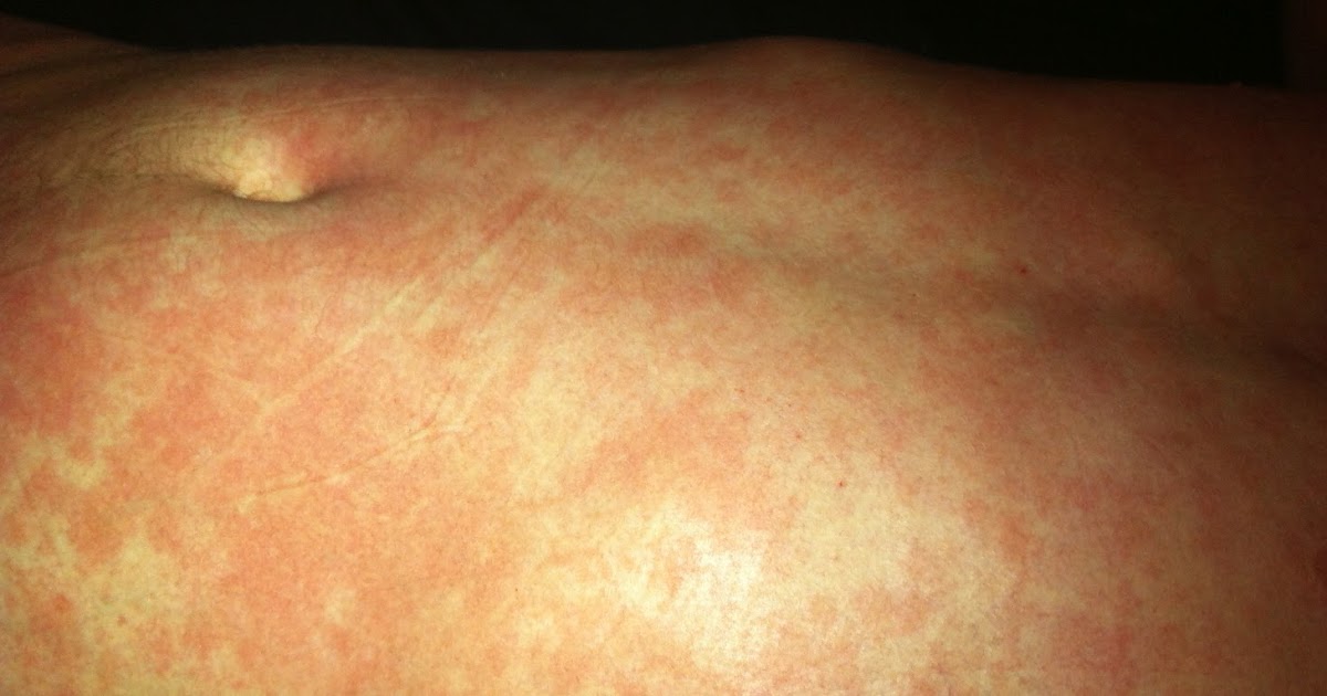 Healing Eczema and Cortisone Withdrawal Symptoms Decision to Withdraw