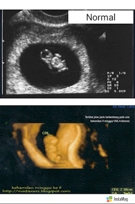 Pada-kehamilan-9-minggu