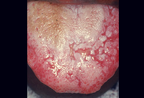 aphthous ulcers on tongue #9