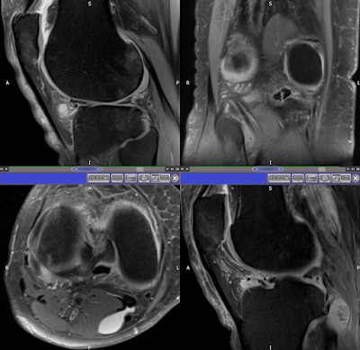 Posterolateral corner injury following twisted knee