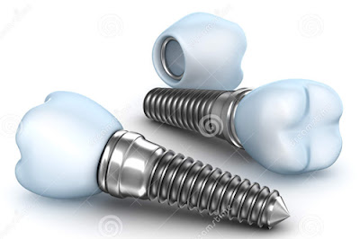 thông tin về chi phí trồng răng implant