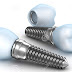 Thông tin về chi phí trồng răng implant