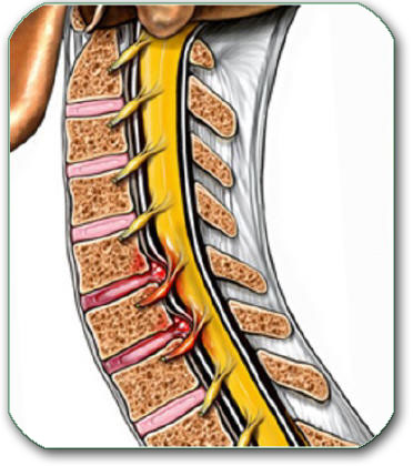 Discus hernia: Vratna kičma