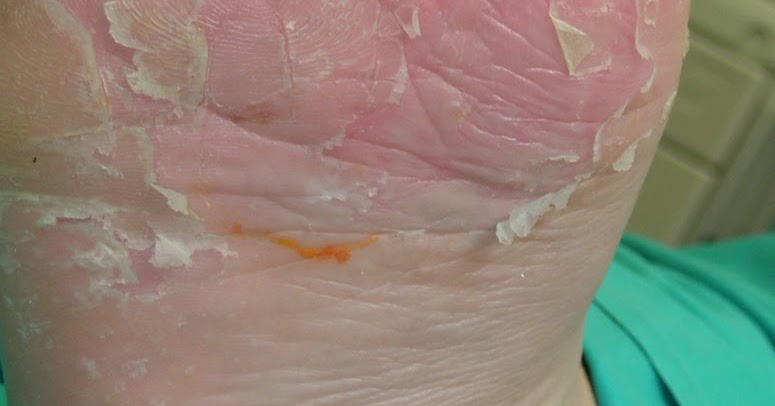 Las cremas a la psoriasis pustular