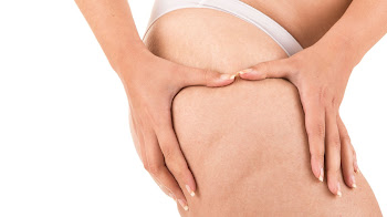 La Celulitis