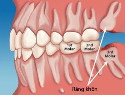 Địa chỉ nhổ răng thừa uy tín