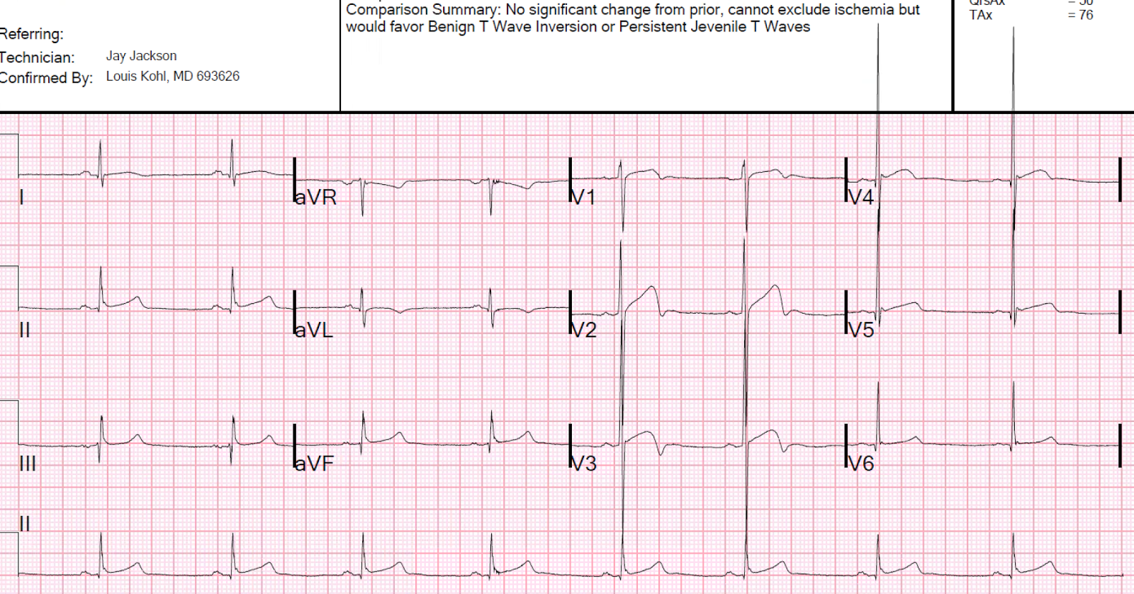 Dr. Smith's ECG Blog 2 Cases of Resolved Chest Pain with Dynamic