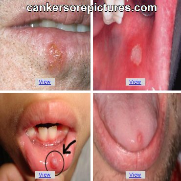 herpes corner of mouth