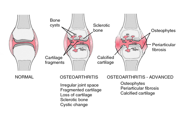 Finger-Osteoarthritis1.jpg