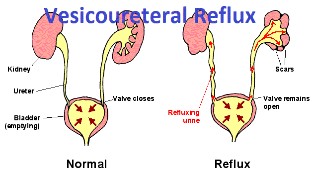 Vesicoureteral Reflux Vur