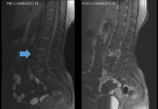 Ultimate Radiology : Aggressive ('Malignant') Hemangioma of Vertebrae
