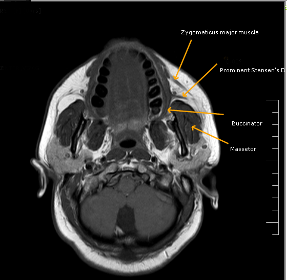 Stensen's DuctMRI Sumer's Radiology Blog