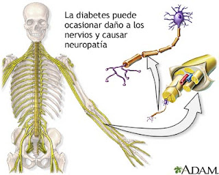 Resultado de imagen para que es la diabetes lesiones nerviosas