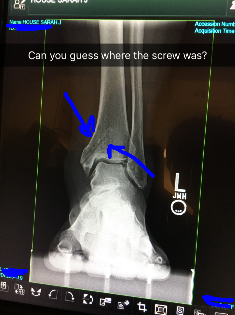 Sarah House 365 My Ankle Hardware Removal