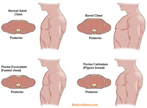 Medicosnotes Com What Are The Abnormal Shape Of Chest