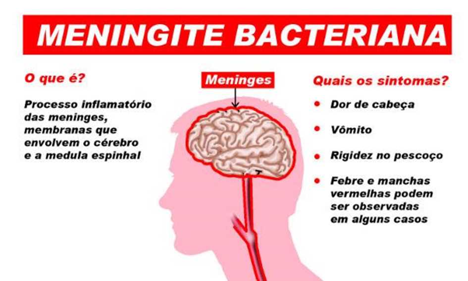Meningite Doença Inflamatória Que Pode Ser Fatal Saúde & Conhecimento Meningite Doença Inflamatória Que Pode Ser Fatal Saúde & Conhecimento
