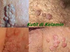 Image Cara Menghilangkan Benjolan Kutil Kelamin Di Vagina