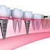  Địa chỉ trồng răng implant uy tín