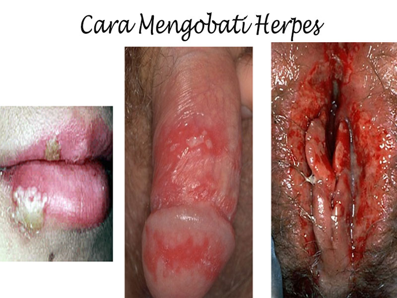 30 cara mengobati herpes kulit secara medis dan alami 30 cara mengobati herpes kulit secara medis dan alami