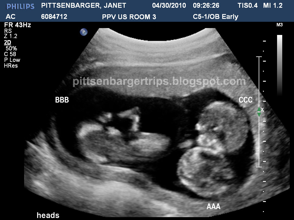 PITTS TRIP'S the Pittsenbarger identical triplets saga 12 week Ultrasound