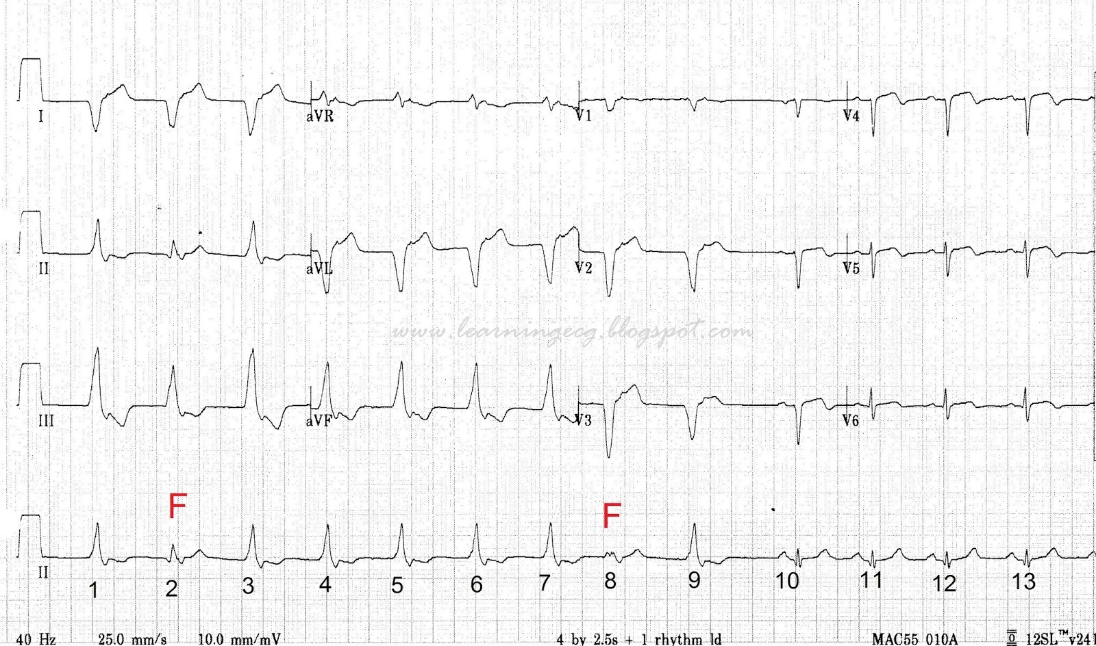 ECG Rhythms Accelerated Idioventricular Rhythm with Fusion beats