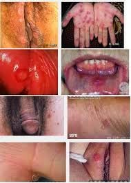 Cara Pengobatan Sifilis Secara Alami Cara Pengobatan Sifilis Secara Alami