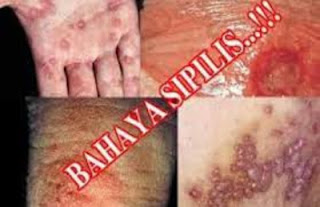 obat paling ampuh menyembuhkan sipilis ringan parah