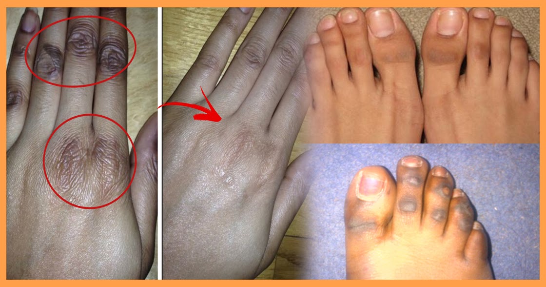 This Is How You Can Get Rid Of Dark Knuckles And Toes Easily At Home