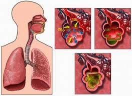 cara mengobati penyakit paru-paru basah