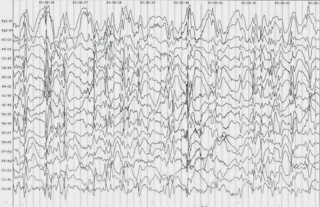 Ээг показывает эпилепсию. Синдром Леннокса-Гасто ЭЭГ. ЭЭГ эпилепсия пик-волна. Рисунок ЭЭГ при эпилепсии. Детская абсансная эпилепсия на ЭЭГ.