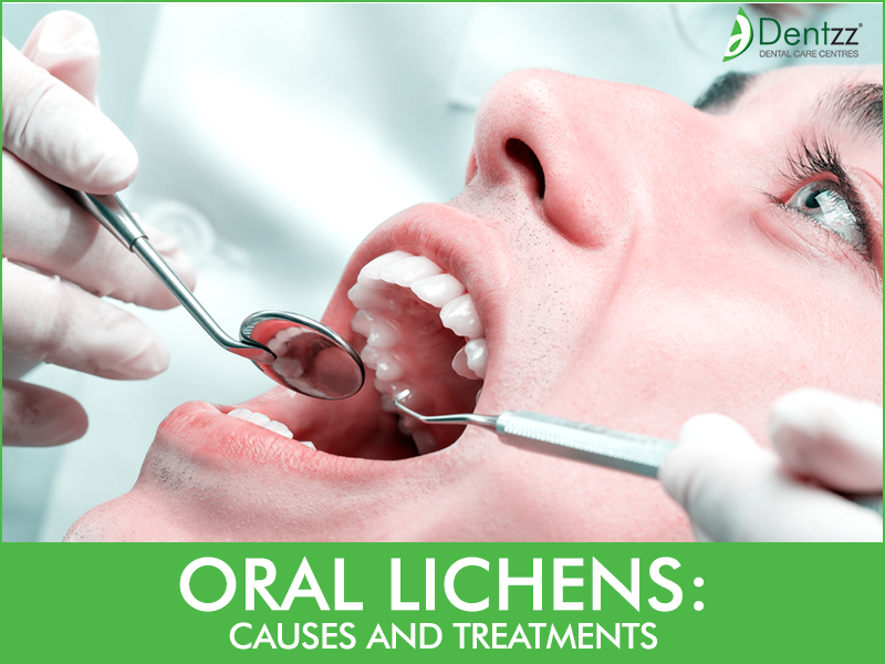 Oral health treatment and consultation by Dentzz Dental Oral Lichen