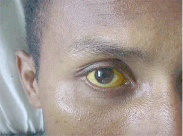 Cara Cepat Memulihkan Mata Kuning Menjadi Putih Cara Cepat Memulihkan Mata Kuning Menjadi Putih