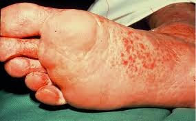 Natural Athletes Foot Cure Tea Tree Natural Athletes Foot Cure Tea Tree
