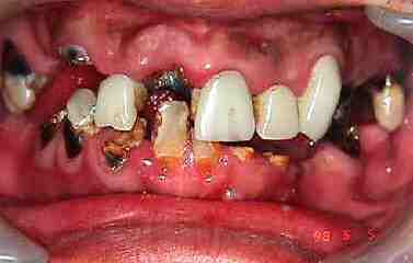 Caries dental Foto de las caries dentales en una persona