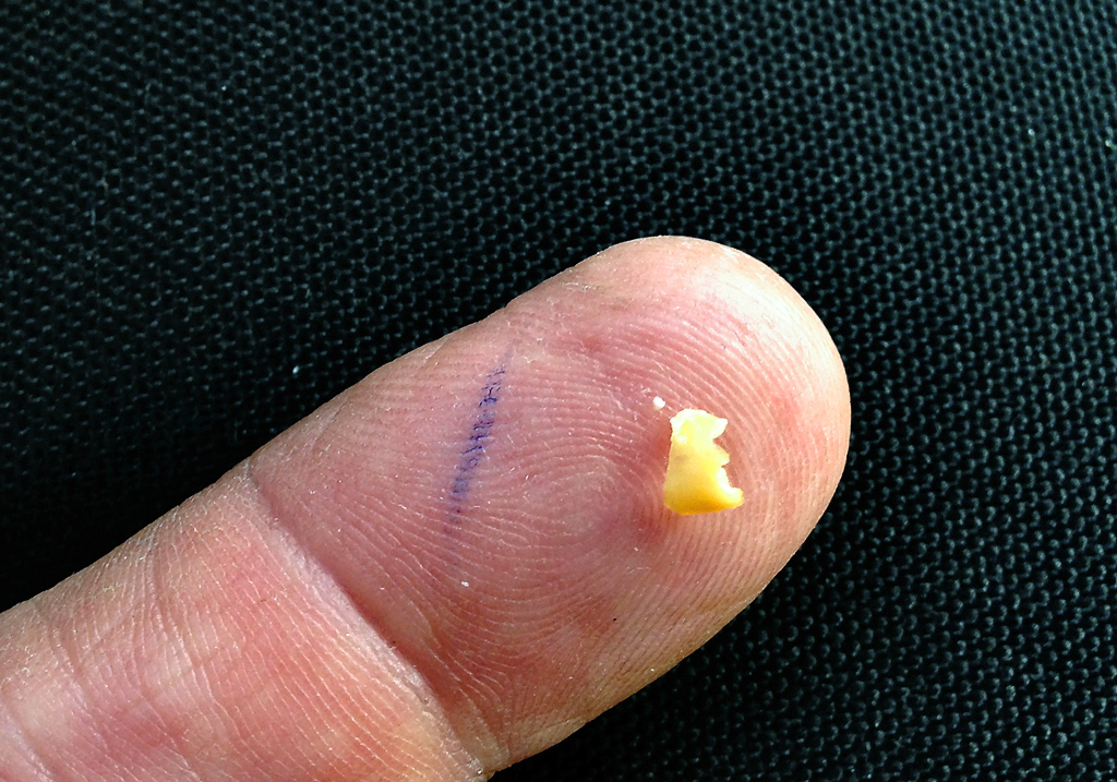 popcorn throat stuck piece tonsil husk lodged cameraman came little