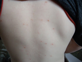 chicken pox spots two weeks