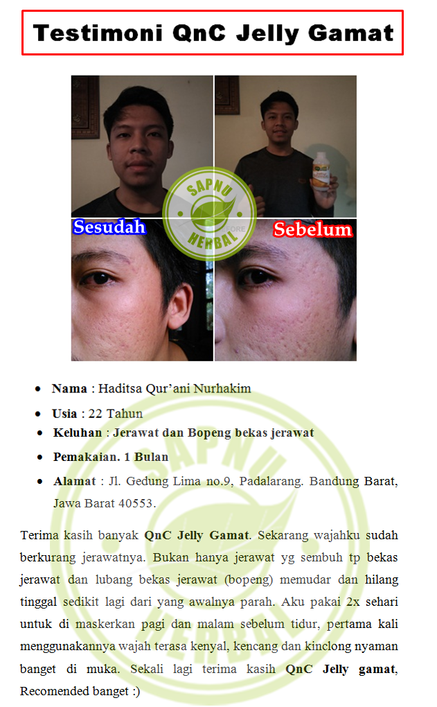 Obat Jerawat Membandel di Pipi, 100% Terbukti MANJUR Mengobati Jerawat Membandel di Pipi Obat Jerawat Membandel di Pipi, 100% Terbukti MANJUR Mengobati Jerawat Membandel di Pipi