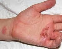 Cara Mengobati Gatal &amp; Bintik Berair Di Telapak Tangan Secara Alami