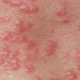 SCABIES (STD) AND ITS EFFECTS (Read)