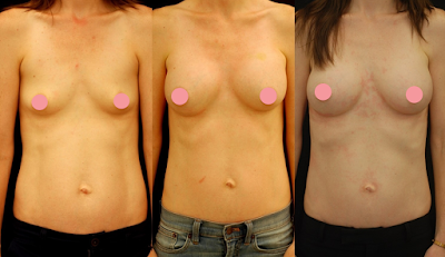 Antes e Depois Mamoplastia de Aumento Antes e Depois Mamoplastia de Aumento