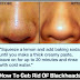 How to Get Rid of Blackheads