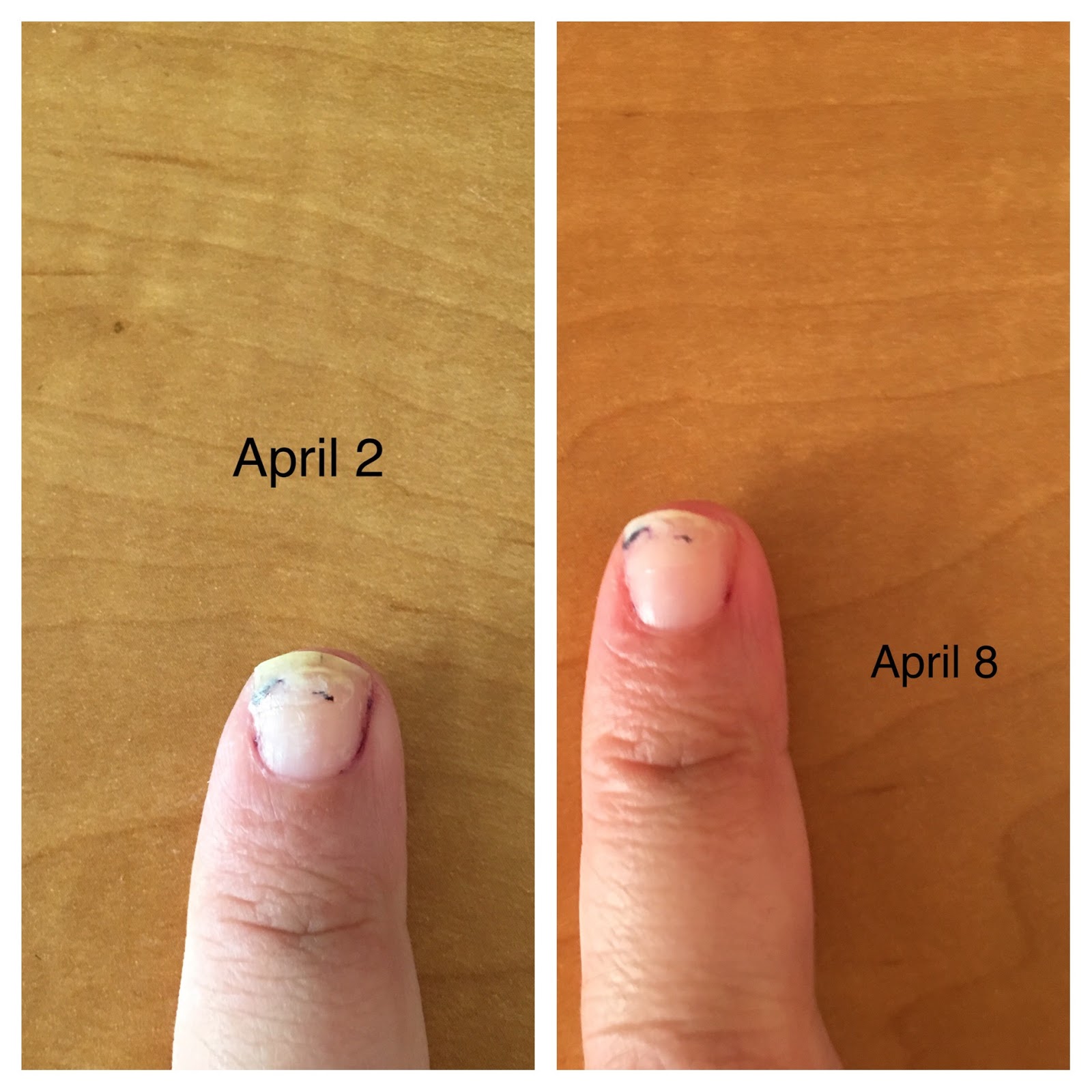 How to Save and Regrow Nails After a Break